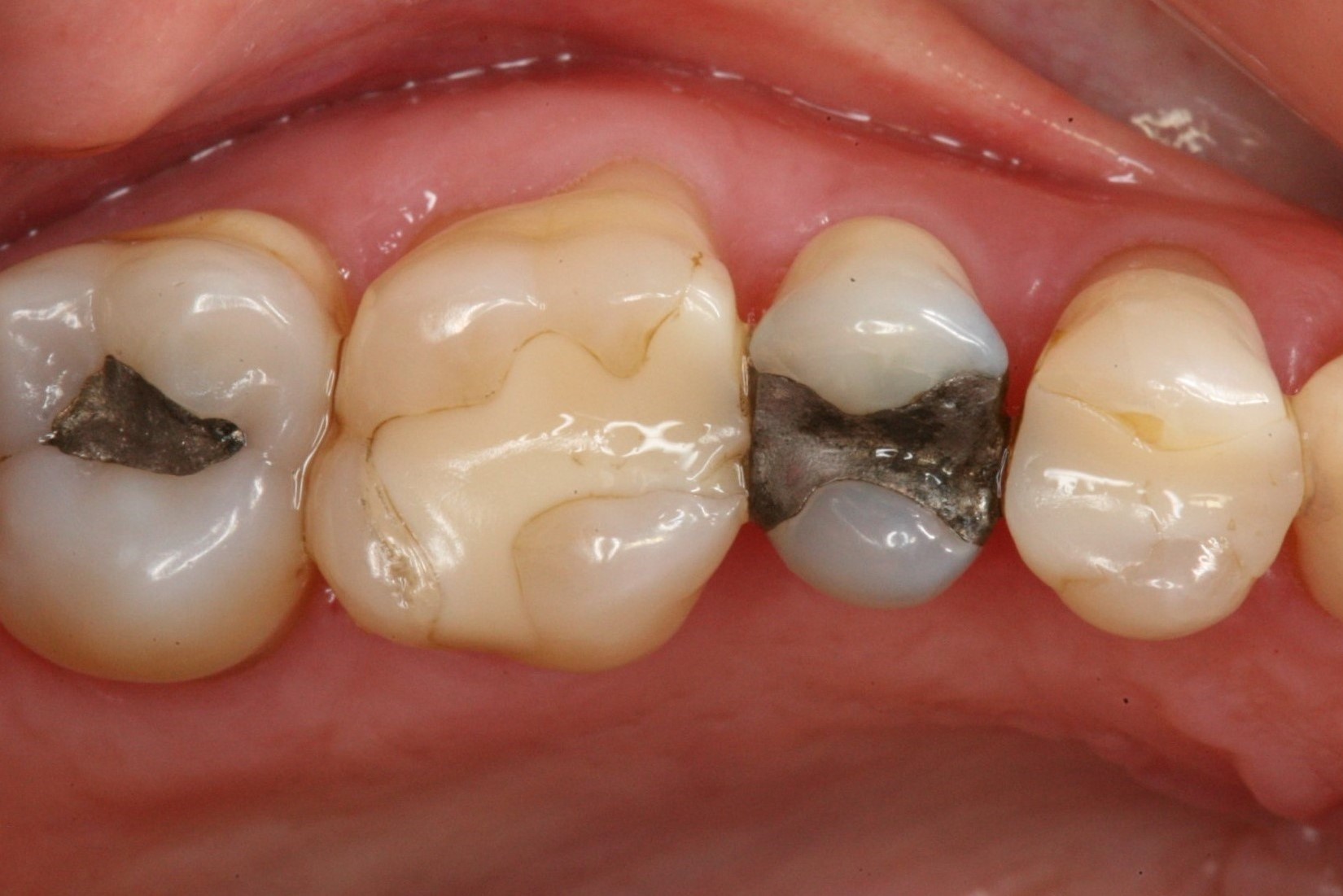 Mercury Safe Dentistry - Insight Dental